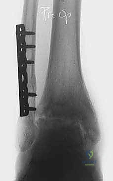 صورة توضيحية لـ تشتيت مفصل الكاحل: حل بيولوجي متقدم لتجديد الغضروف وتخفيف الألم مع الأستاذ الدكتور محمد هطيف