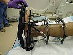 تطبيق قوة التشتيت لفتح المفصل