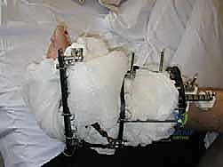 صورة توضيحية لـ تشتيت مفصل الكاحل: حل بيولوجي متقدم لتجديد الغضروف وتخفيف الألم مع الأستاذ الدكتور محمد هطيف