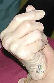 صورة توضيحية لـ تمزق أوتار اليد والمعصم الروماتويدي: دليل شامل للعلاج والتعافي مع الأستاذ الدكتور محمد هطيف في صنعاء