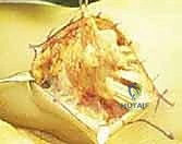 صورة توضيحية لتضخم الغشاء الزليلي المؤدي لتمزق الأوتار