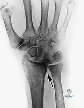 تشريح أوتار اليد والمعصم