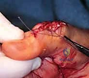 اختبار حركة الوتر أثناء الجراحة