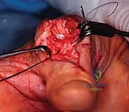 إصلاح الأوتار الممزقة