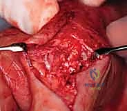 استعادة حركة الأصابع بعد التأهيل