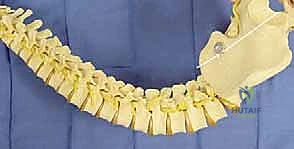 Masterclass: Unit Rod Instrumentation for Neuromuscular Scoliosis Correction