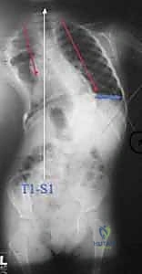 الأسباب الهيكلية لجنف الأطفال المبكر