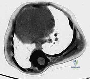 التشخيص الإشعاعي الدقيق للجنف