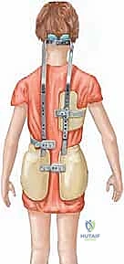 الخيارات التحفظية لعلاج الجنف
