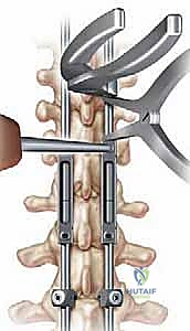 صورة توضيحية لـ علاج جنف الأطفال المبكر بقضبان النمو: دليل شامل للآباء مع الأستاذ الدكتور محمد هطيف