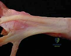 تأثير التهاب المفاصل الروماتويدي على اليد