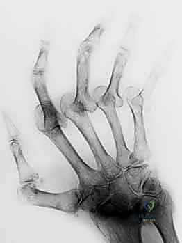 صورة توضيحية لـ تشوه العروة وتشوه عنق البجعة في اليد: دليل شامل للعلاج وإعادة التأهيل مع الأستاذ الدكتور محمد هطيف