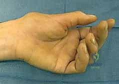 إعادة بناء الأوتار المتمزقة