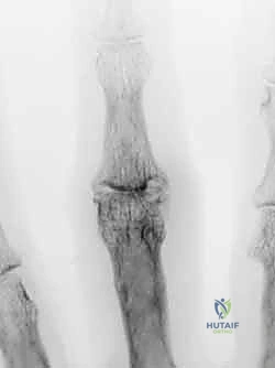 صورة توضيحية لـ تشوه العروة وتشوه عنق البجعة في اليد: دليل شامل للعلاج وإعادة التأهيل مع الأستاذ الدكتور محمد هطيف