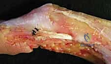 الفحص السريري الدقيق لتشوهات الأصابع