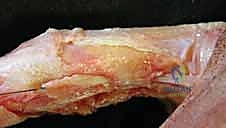 استخدام التقنيات الميكروسكوبية في جراحة اليد