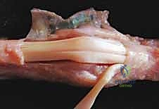 صورة توضيحية لـ تشوه العروة وتشوه عنق البجعة في اليد: دليل شامل للعلاج وإعادة التأهيل مع الأستاذ الدكتور محمد هطيف