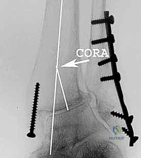 صورة توضيحية لـ جراحة تقويم عظم الظنبوب فوق الكعب: حل متقدم للحفاظ على مفصل الكاحل وعلاج خشونة الكاحل مع الأستاذ الدكتور محمد هطيف