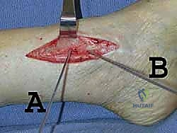 خطوات إجراء الشق الجراحي والوصول للعظم