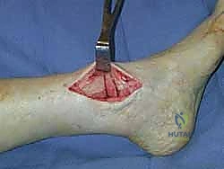 ميكانيكا مفصل الكاحل وتوزيع الأحمال