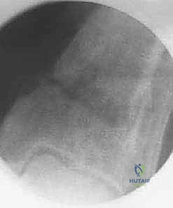 تعديل زاوية العظم وإعادة المحاذاة