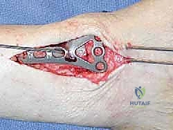 تآكل الغضروف وخشونة مفصل الكاحل