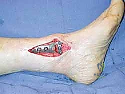 تخطيط جراحة تقويم عظم الظنبوب