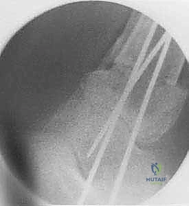 المتابعة الدورية وصور الأشعة بعد الالتئام