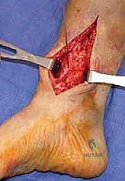 تأثير التشوه المحوري على الكاحل