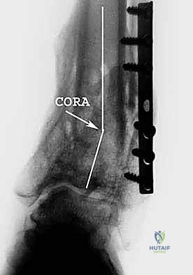 الأدوات الجراحية الدقيقة المستخدمة في العملية