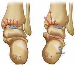 تطور خشونة مفصل الكاحل من النوع التقوسي بمرور الوقت