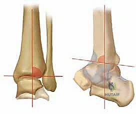 مقارنة التخطيط الجراحي بين الخيارات المختلفة لعلاج الكاحل