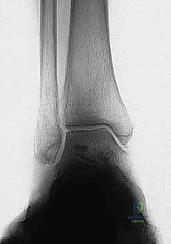 الأسباب الميكانيكية والإصابات التي تؤدي إلى خشونة الكاحل