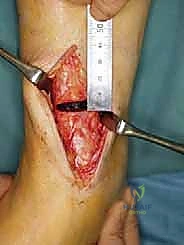 صورة توضيحية لـ جراحة قطع عظم الساق فوق الكاحل لعلاج خشونة مفصل الكاحل بتقنية الوتد المفتوح: دليل شامل مع الأستاذ الدكتور محمد هطيف