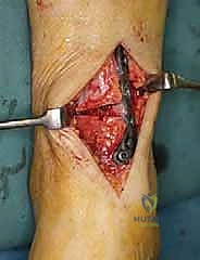 صورة طبية: جراحة قطع عظم الساق فوق الكاحل لعلاج خشونة مفصل الكاحل بتقنية الوتد المفتوح: دليل شامل مع الأستاذ الدكتور محمد هطيف