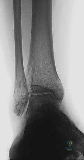 صورة طبية: جراحة قطع عظم الساق فوق الكاحل لعلاج خشونة مفصل الكاحل بتقنية الوتد المفتوح: دليل شامل مع الأستاذ الدكتور محمد هطيف