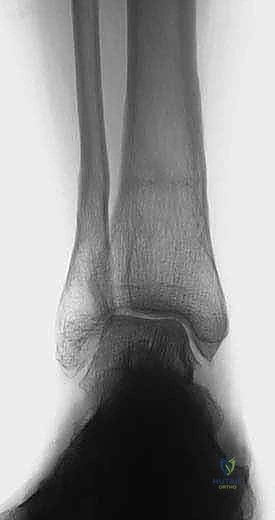Illustration of osteotomy with internal - Dr. Mohammed Hutaif
