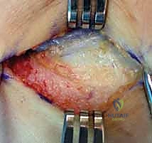 صورة توضيحية لـ مرفق التنس: الدليل الشامل لعلاج التهاب اللقيمة الوحشية مع الأستاذ الدكتور محمد هطيف