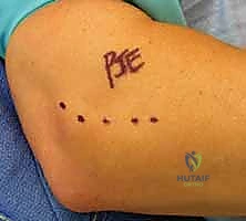 عملية تقشير العظم لتحفيز التروية الدموية