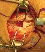 التغيرات الباثولوجية والتنكسية في وتر الكوع