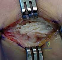 التشريح الجراحي لأوتار الكوع واللقيمة الوحشية