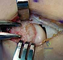 مرفق التنس: الدليل الشامل لعلاج التهاب اللقيمة الوحشية مع الأستاذ الدكتور محمد هطيف