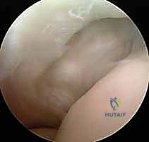 استئصال الأنسجة المتضررة أثناء الجراحة المفتوحة