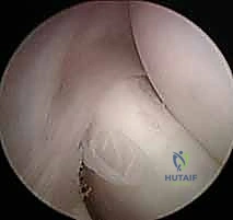 التحضير للعملية الجراحية لمرفق التنس