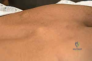 صورة توضيحية لـ تثبيت الفقرات الخلفي الجانبي للانزلاق الفقاري: دليل شامل للمرضى مع الأستاذ الدكتور محمد هطيف