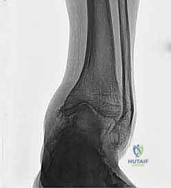 التخطيط الجراحي لعملية قطع العظم