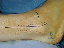 تشريح مفصل الكاحل وعظام الساق