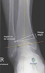 صورة توضيحية لـ قطع العظم فوق الكاحل الحل الأمثل لتشوهات الكاحل وآلامه المزمنة