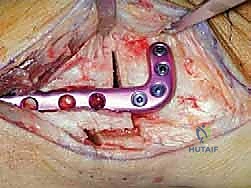 الأستاذ الدكتور محمد هطيف أثناء الجراحة الميكروسكوبية