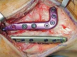 صورة توضيحية لـ قطع العظم فوق الكاحل الحل الأمثل لتشوهات الكاحل وآلامه المزمنة